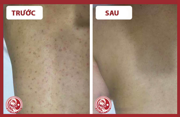 Hình ảnh trước và sau điều trị viêm da dầu ở lưng của bạn Hoàng Nam