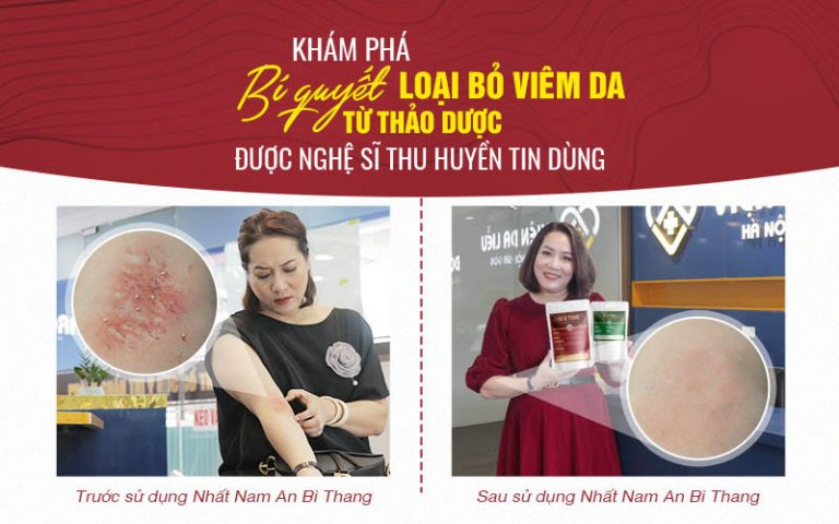 Diễn viên Thu Huyền trước và sau 2 tháng điều trị viêm da bằng Nhất Nam An Bì Thang