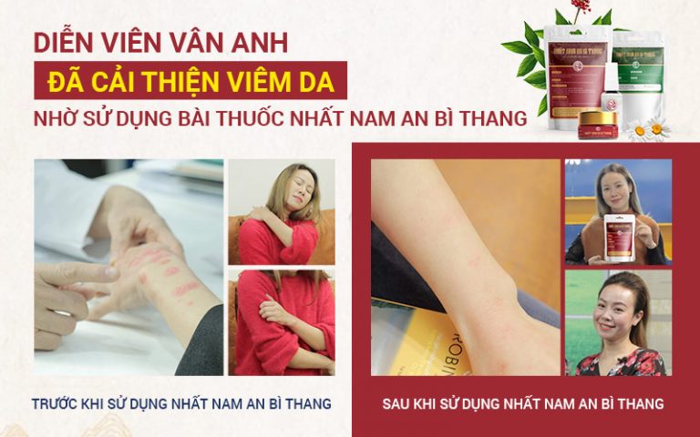 Tình trạng viêm da của diễn viên Vân Anh được cải thiện sau 1 liệu trình sử dụng Nhất Nam An Bì Thang