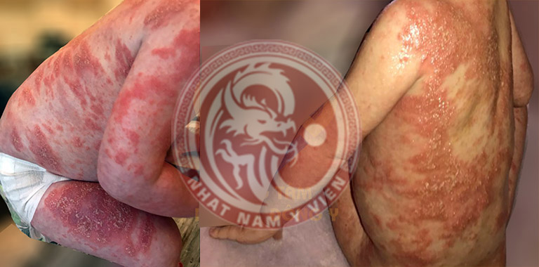 Một bệnh nhân nhỉ tuổi bị vảy nến nặng được Trung tâm Da liễu Đông y Việt Nam tiếp nhận điều trị