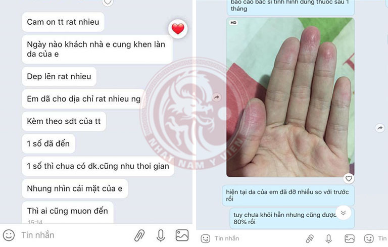 Bệnh nhân viêm da tiếp xúc gửi phản hồi đến Trung tâm Da liễu Đông y Việt Nam
