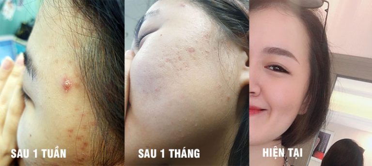 Làn da của cô bé Hoàng Chi đã thay đổi 180 độ, không còn tự ti vì mặt mụn nữa