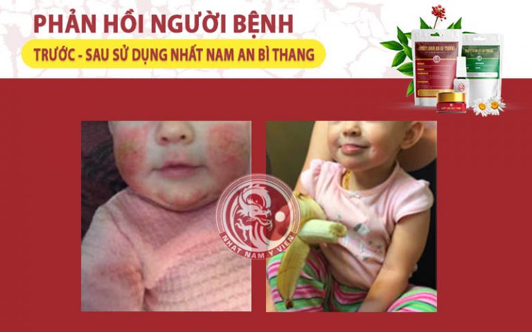 Sau 3 tháng dùng Nhất Nam An Bì Thang, tình trạng viêm da dị ứng của bé Lan Anh đã được xử lý hoàn toàn