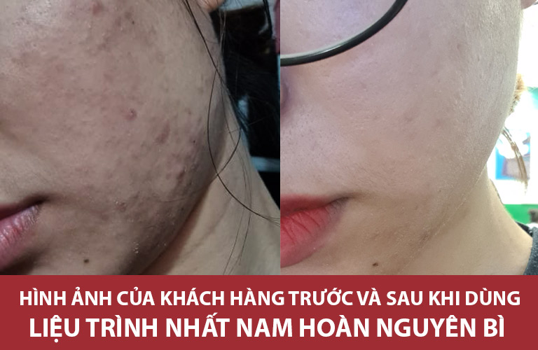 Hình ảnh làn da của một số khách hàng trước và sau khi điều trị mụn với liệu trình thảo dược Nhất Nam Hoàn Nguyên Bì