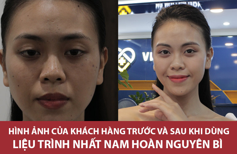 Chị Trang (27 tuổi, nhân viên ngân hàng) là người đã từng sử dụng Nhất Nam Hoàn Nguyên Bì để trị mụn ẩn, mụn cám, mụn đầu đen trên da và có được kết quả khá tốt