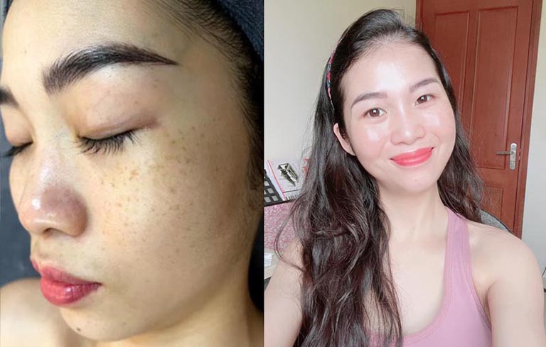 Da mặt của chị Trang trước và sau khi sử dụng liệu trình Vương Phi