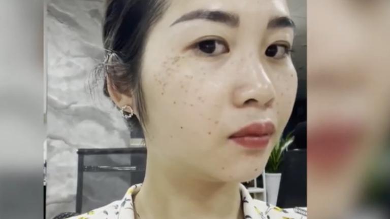 Ngô Huyền Trang với làn da bị tàn nhang do di truyền, đốm tàn nhang