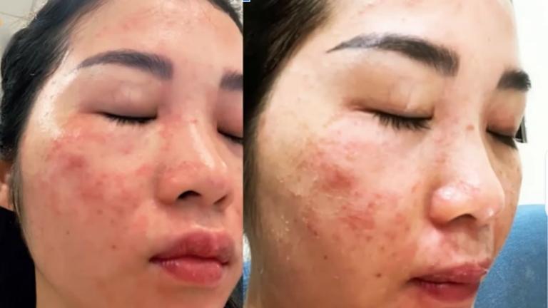 Làn da của chị Trang bị tổn thương do sử dụng laser