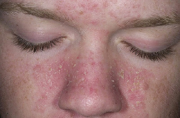 Hình ảnh viêm da tiếp xúc dị ứng ở mặt