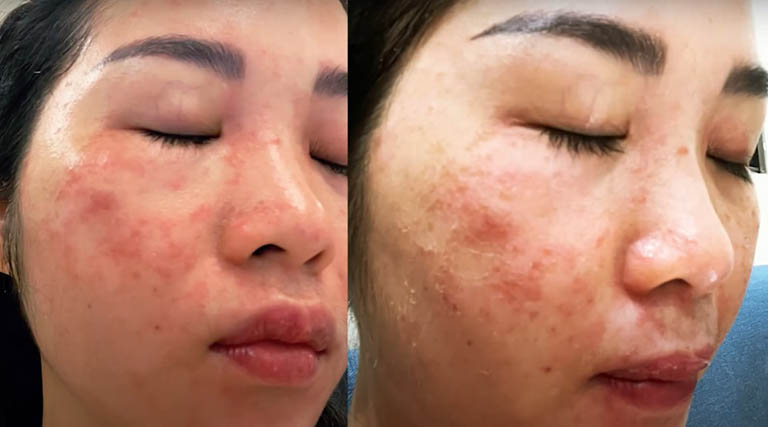 Làn da bị tổn thương sau khi laser sai cách của chị Huyền Trang