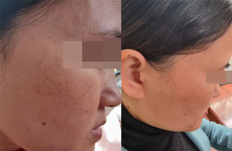 Làn da của chị Hương Linh thay đổi nhiều chỉ sau 2 tháng dùng Vương Phi