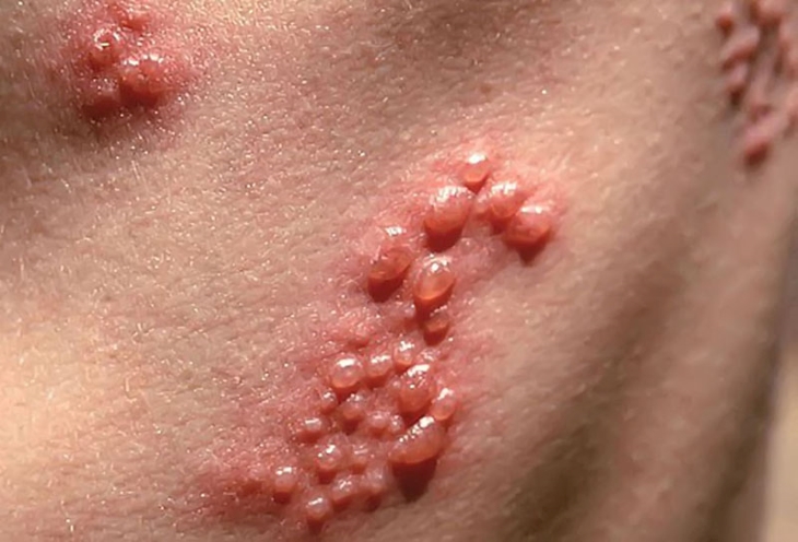 Bệnh viêm da Herpes do virus Herpes gây nên