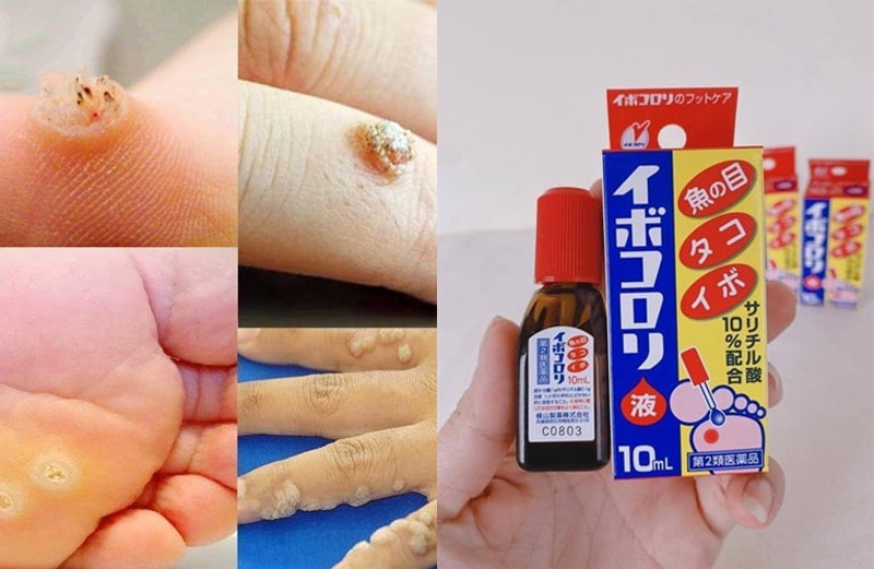 Ibokorori - Loại thuốc trị mụn cóc của Nhật được ưa chuộng nhất