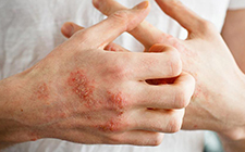 Bệnh Chàm (Eczema)