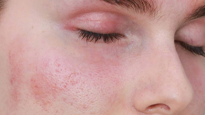 Làn da bị dị ứng có thể do nhiều yếu tố tác động cả trong lẫn ngoài