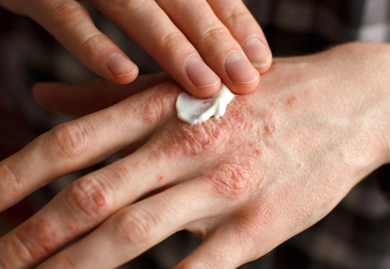 Dùng thuốc bôi bạt sừng và dưỡng ẩm da cũng là giải pháp giúp bạn kiểm soát bệnh vảy nến hiệu quả