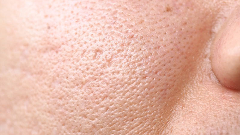 Da mặt lỗ chân lông to có thể do da đổ nhiều dầu