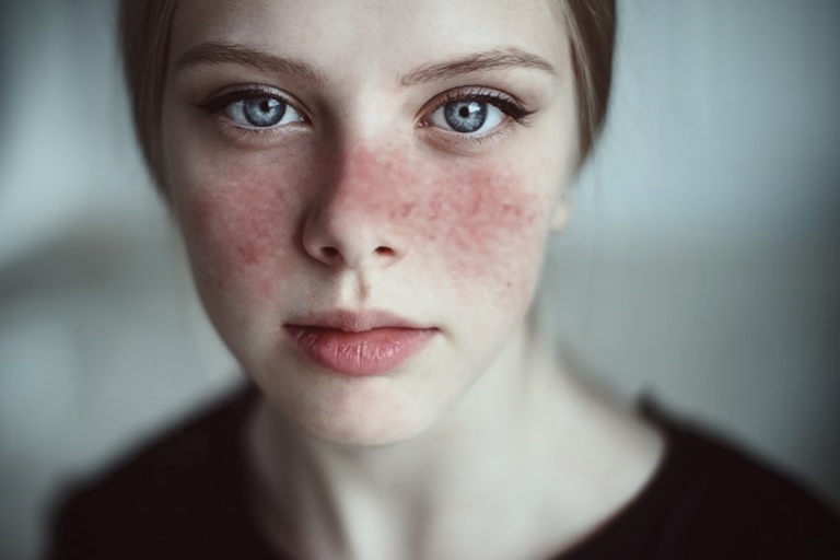 Bệnh lupus ban đỏ có thể gặp ở một số người bị bệnh mề đay