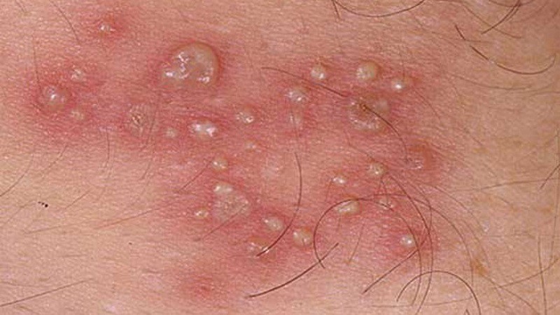 Herpes sinh dục cũng là nguyên nhân xuất hiện mụn bọc ở môi lớn vùng kín