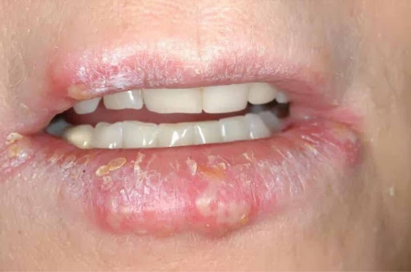 Chàm môi là căn bệnh da liễu với những vết thương xuất hiện ở môi trên và môi dưới