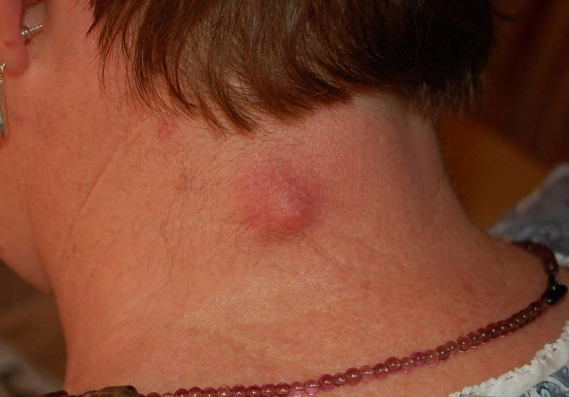 Mụn nhọt ở cổ là tình trạng da bị da bị nhiễm trùng trong một nang lông hoặc tuyến bã