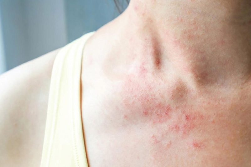 Người bệnh có thể bị ngứa dữ dội khi gặp bệnh chàm da