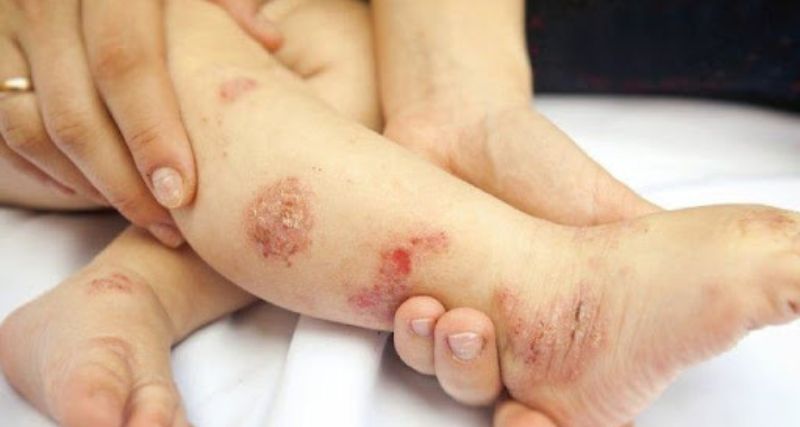Loét da thường gặp ở bệnh nhân bị bội nhiễm, nhiễm trùng trên nền da tổn thương