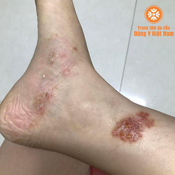 Triệu chứng loét da bệnh nhân viêm da cơ địa tại Trung tâm da liễu đông y Việt Nam