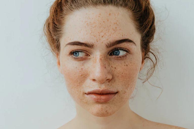Tàn nhang là vấn đề tăng sắc tố da phổ biến ở chị em phụ nữ